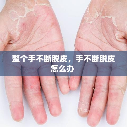 整个手不断脱皮，手不断脱皮怎么办 