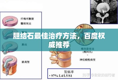 胆结石最佳治疗方法，百度权威推荐