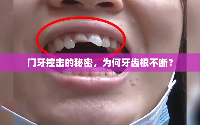 门牙撞击的秘密，为何牙齿根不断？
